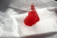 خونریزی روده کوچک